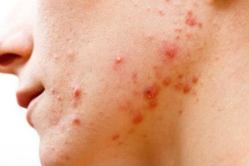 脸上长痘痘的位置和原因 鼻头长痘胃火大且消化异常