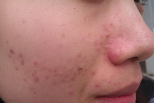 脸上长痘痘的位置和原因 鼻头长痘胃火大且消化异常