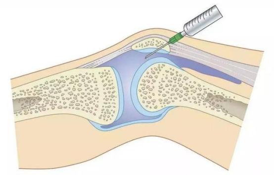 小孩膝关节积液是什么造成的 小孩膝关节积液是什么造成的(2)