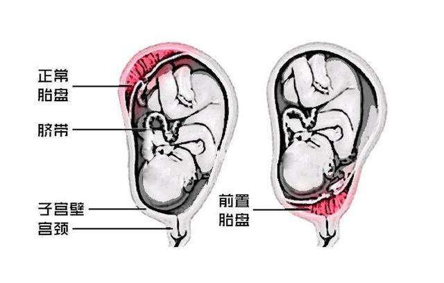 孕妇胎盘后壁注意什么 孕妇胎盘前壁好还是后壁好(3)